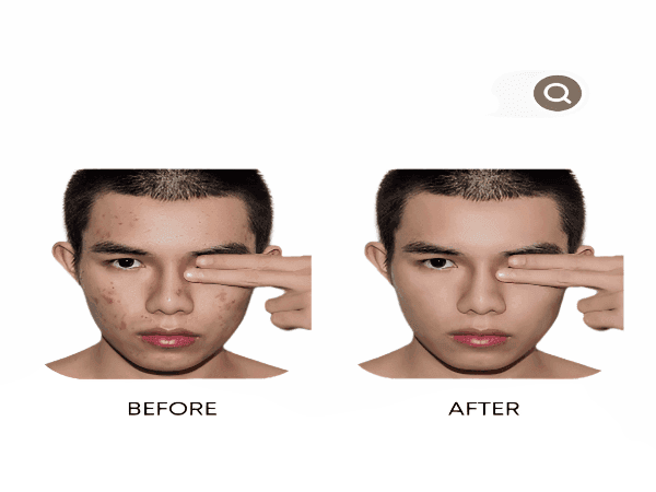 Organic Anti-Acne Three-Step System - Moderate/Severe Acne Prone Skin - For MEN-1